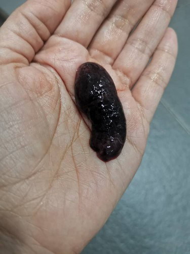 Minta pendapat pls. UPT and darah negative. Bleeding 11/3 - 21/3 then keluar ketulan darah