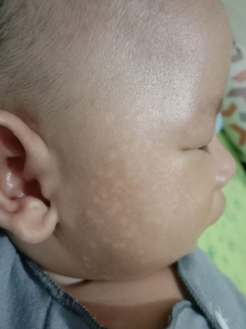 Bun anak aq 2 bln tpi timbul becak putih gini di muka,cara ngilain nya kek mana ya Bun??