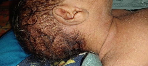 Bruntusan merah dari  kaki sampai kepala pada new born