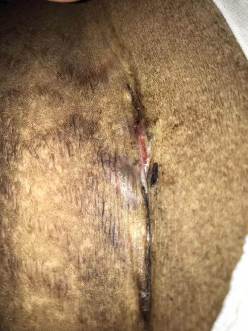 bekas operasi caesar