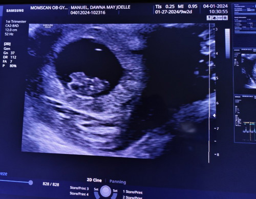 No More subchorionic hematoma