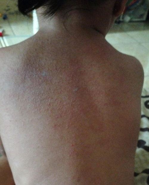 Eksim atau biang keringat