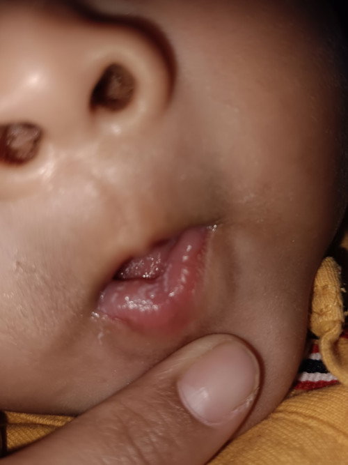 Mulut lidah putih
