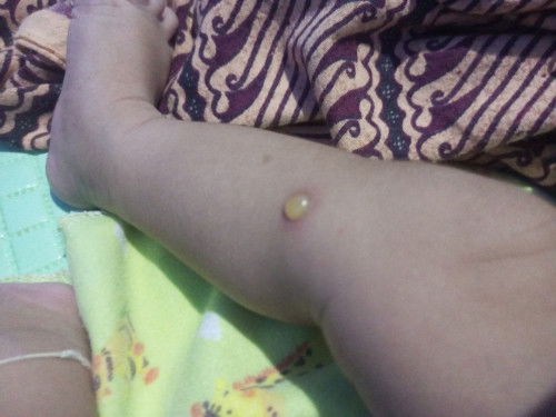 Bintik berair dan makin banyak