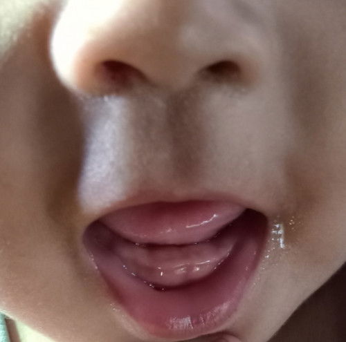 แบบนี้ใช่ฟันใกล้ขึ้นหรือเปล่าคะ