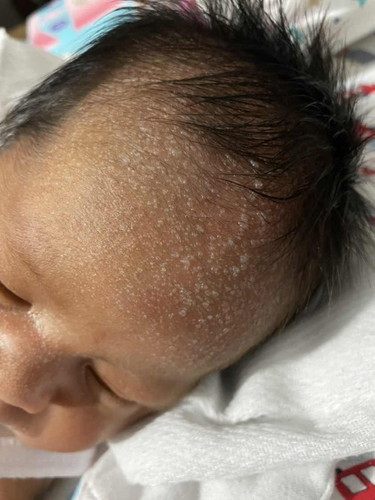 1 week newborn baby skin problem
