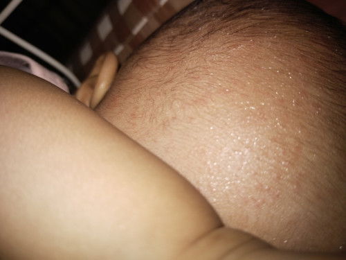 ผื่นนขึ้นไม่สบาย