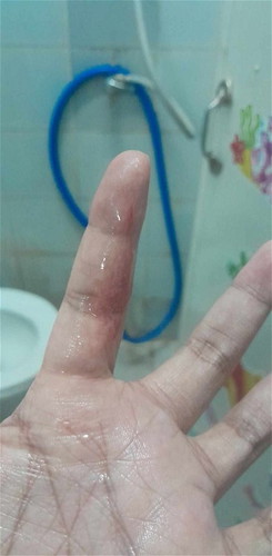 มีมูกปนเลือดไหลออกมาแต่ไม่เยอะ