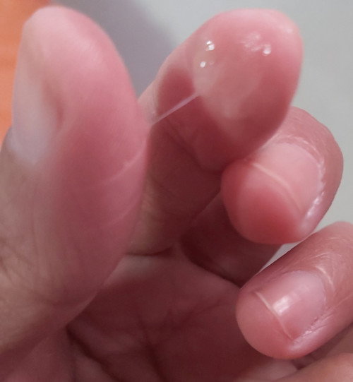 Vaginal Discharge