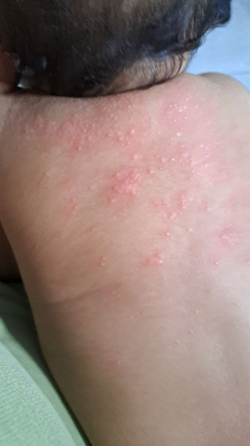 Bintik bintik merah di punggung