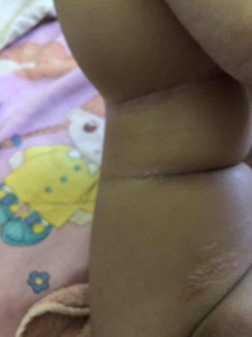 Cara mehilangkan bintik2 merah