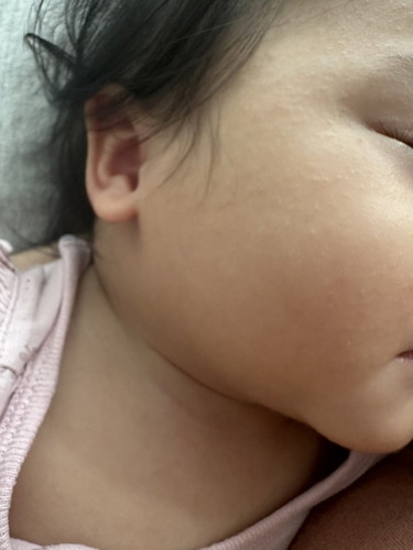 Banyak kluar berbiji2 kecil di muka, badan , leher, peha anak