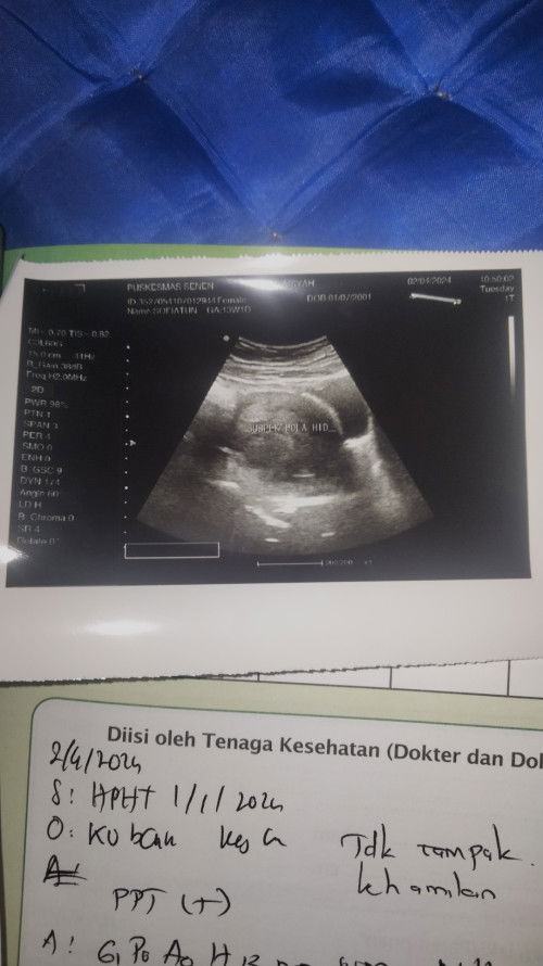 Usg Tidak nampak kantung kehamilan di usia kandungan 13 minggu