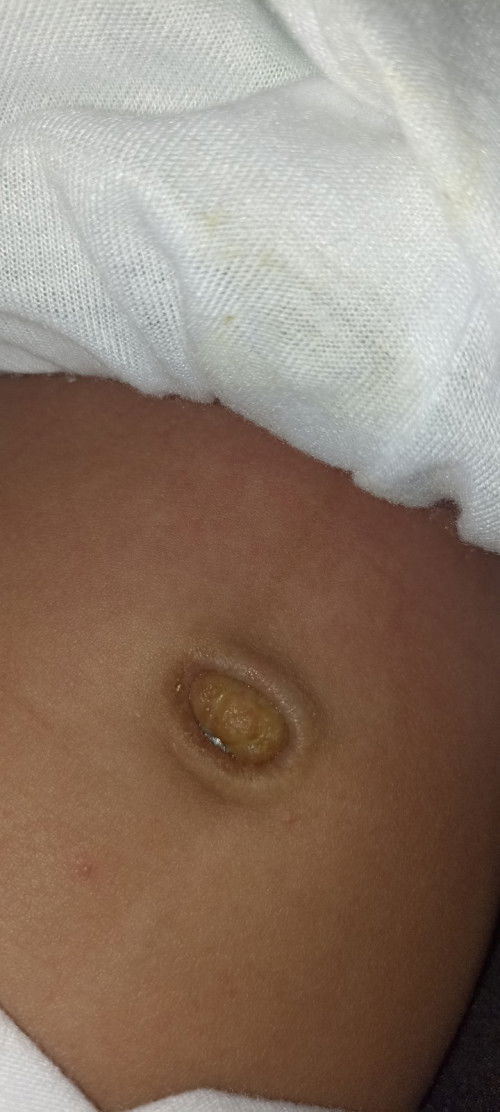 Hello mga momshie ask ko lng po mag 1 month na po ang LO ko normal lang po ba itong pusod nya.?