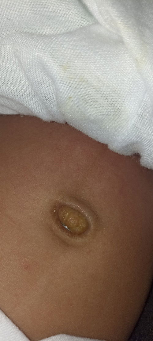 Mga momshie ask ko lng normal lang po ba pusod ng LO ko mga 1 month na po sya pahelp po