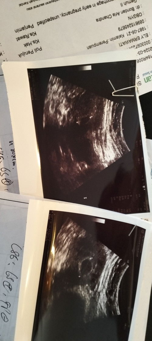 5 week flek 6 week penadarah tapi masih merasakan teller kehamilan