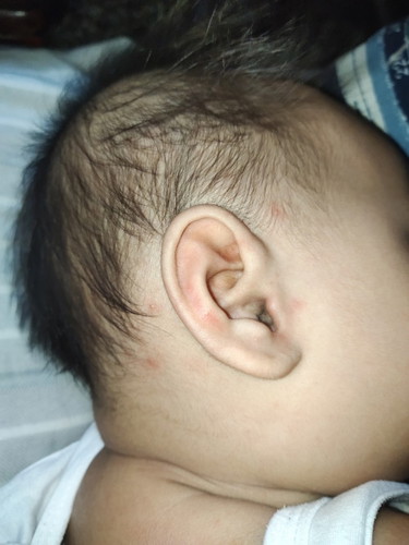 QUESTION ABOUT RED ITCHY EARS?/ BAKIT PO KAYA NAG RRED AT MAKATI YUNG TENGA NI BABY