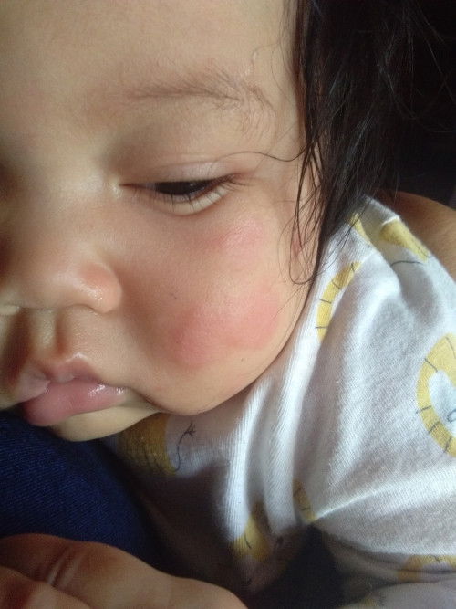 Ruam merah pipi dan paha