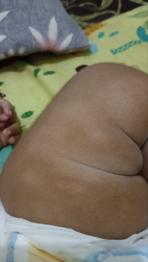 Bercak putih