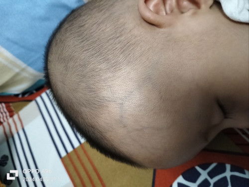 nổi gân xanh ở trẻ