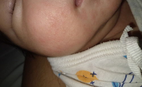 ผื่น เป็นเม็ดใส+สากแข็งๆ🥹