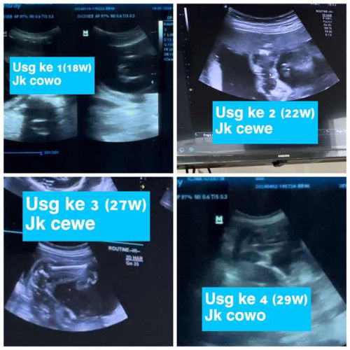 Usg 4x beda dokter beda hasil