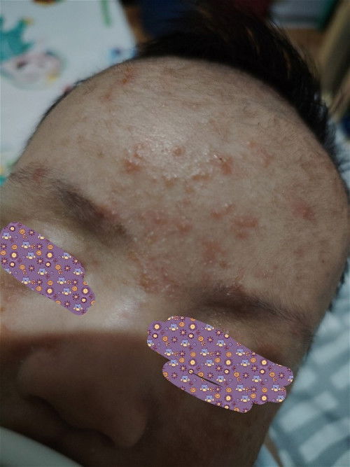 DRY SKIN AT RASHES SA MUKHA, BATOK AT SCALP NG 1 MONTH OLD NA BABY