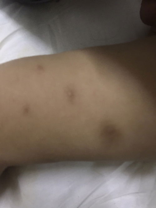 ลูกขาลายยุงกัด