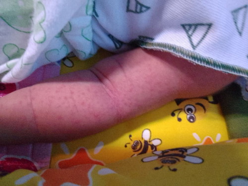 bintik bintik merah seluruh tubuh