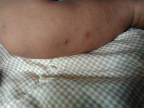 Kulit bayi melenting sampe gosong gosong