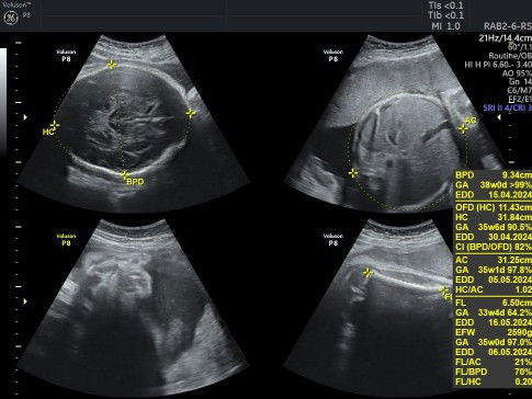 BPD janin lebih besar dari usia kehamilan