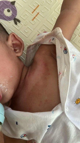 Eczema atau apa