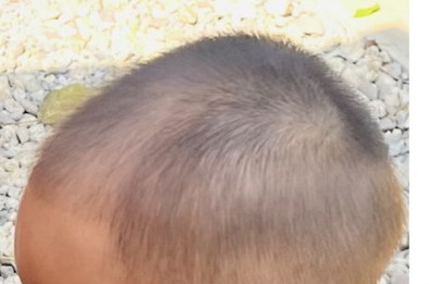 ลูกผมบ้างผิดปกติ