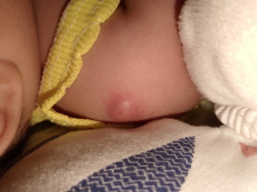 Tanong lang po, may maliit na butol si baby sa knang balikat. Delikado po Kaya.