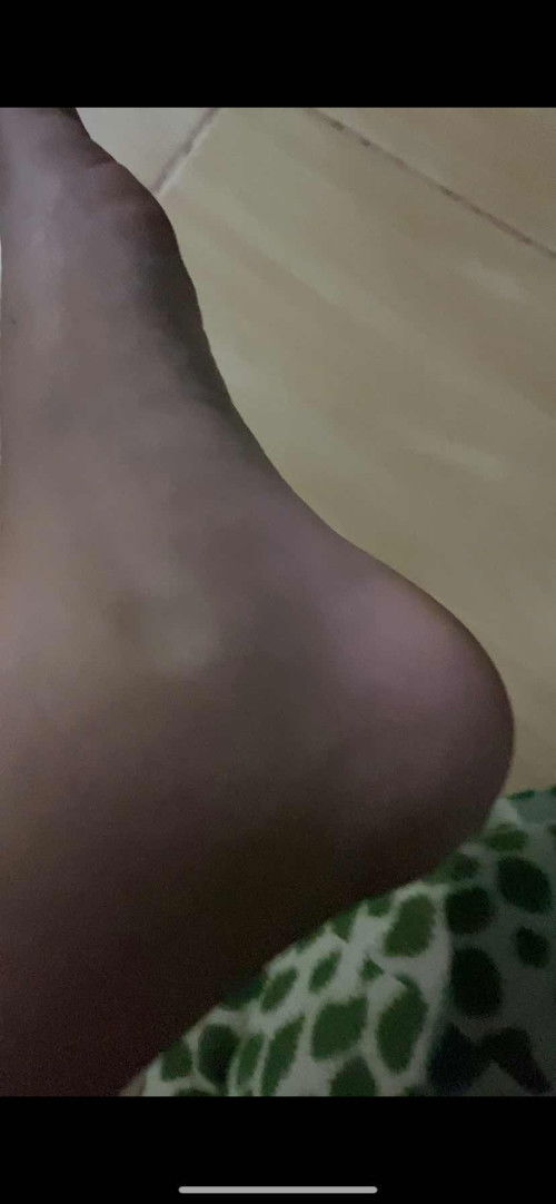 เสี่ยงครรภ์เป็นพิษ