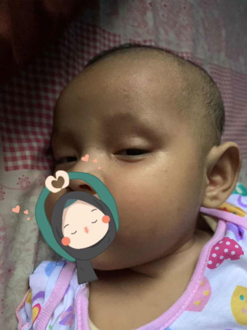 Mata bayi cekung atau tidak