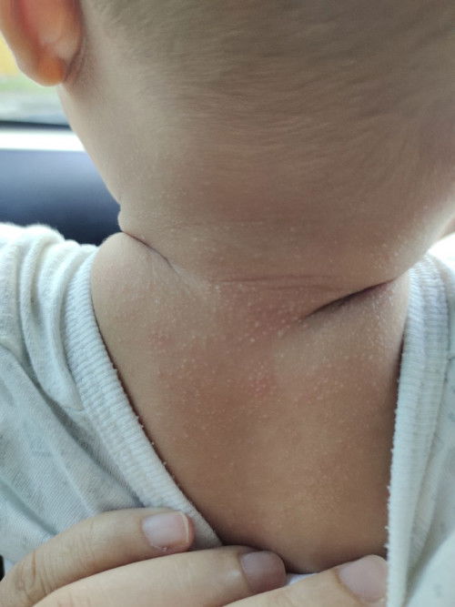 Biji2 kecil dibadan baby