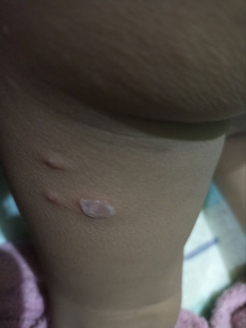 Gatal berair dan melepuh