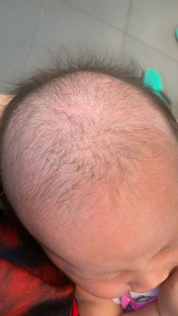 TLG SUGGEST APA YG SESUAI UTK HILANGKN NI KAT KEPALA BABY