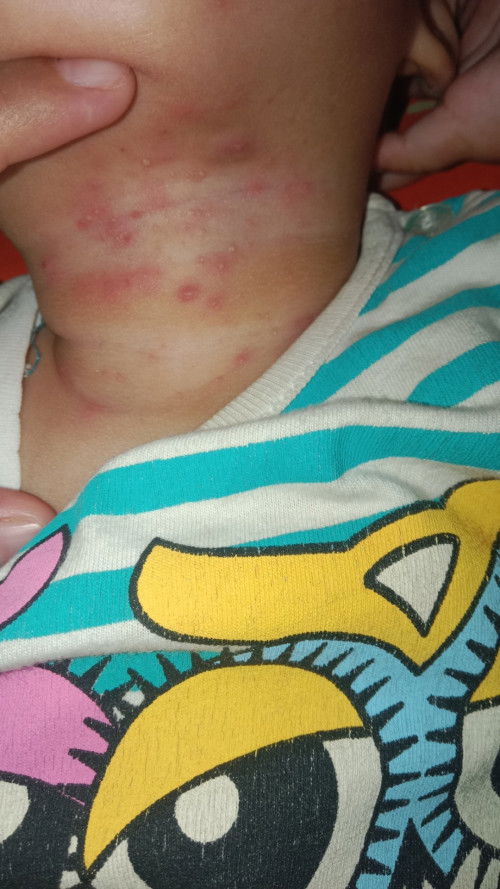 Assalamu'alaikum bunda2 mau tanya ini bintik merah bernanah ini kenpa ya apakah alergi atau apa?