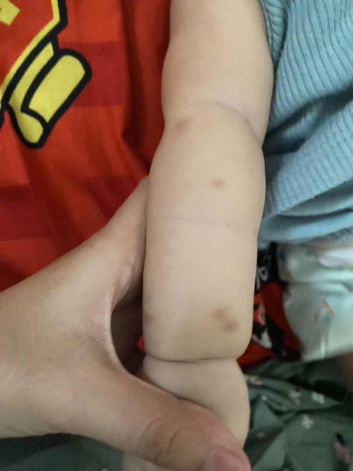 Gatal atau gigitan nyamuk