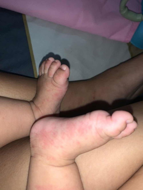 Bintik merah pada kaki dan tangan bayi