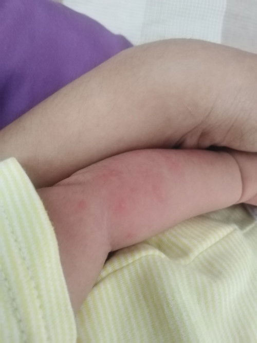 สวัสดี​ค่ะ​แม่แม่ตอนนี้เจ้าตัวเล็กได้8วันแม่อาการขึ้นเม็ดๆตามรูปเลยค่ะ