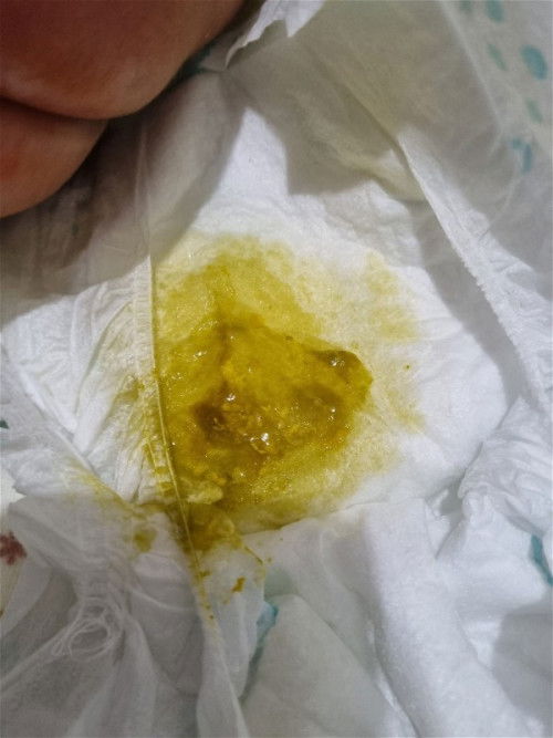 Bayi 1 bulan feses warna kuning kehijauan