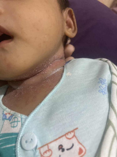 Bund ada yang tau ngak ya ini kenapa ??
Udah pakai crem tapi masih aja blum sembuh