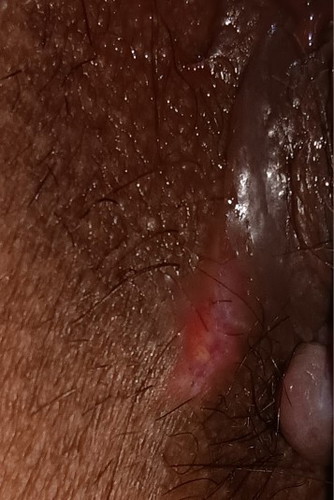 แผลฝีเย็บหลังคลอดลูก