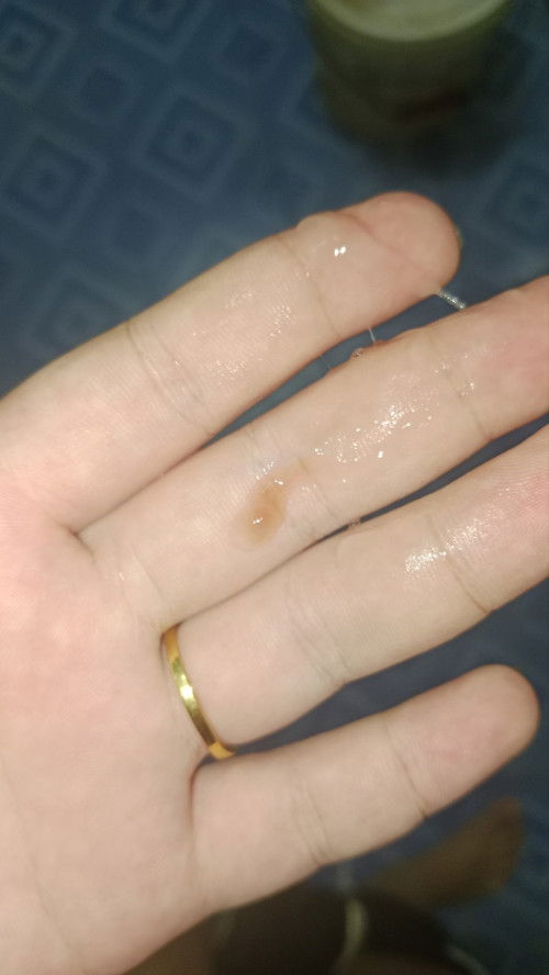 ผ่าคลอดท้อง