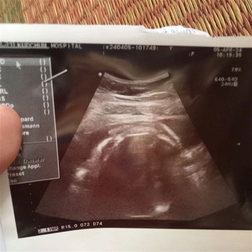 35+2W น้องกลับหัวแล้วอีกนานไหมต่ะกว่าจะคลอด ท้องแรกค่ะ ตั้งใจคลอดเองกลัวมากๆ