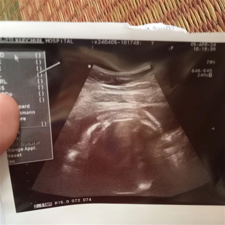 35+2W น้องกลับหัวแล้วอีกนานไหมต่ะกว่าจะคลอด ท้องแรกค่ะ ตั้งใจคลอดเองกลัวมากๆ