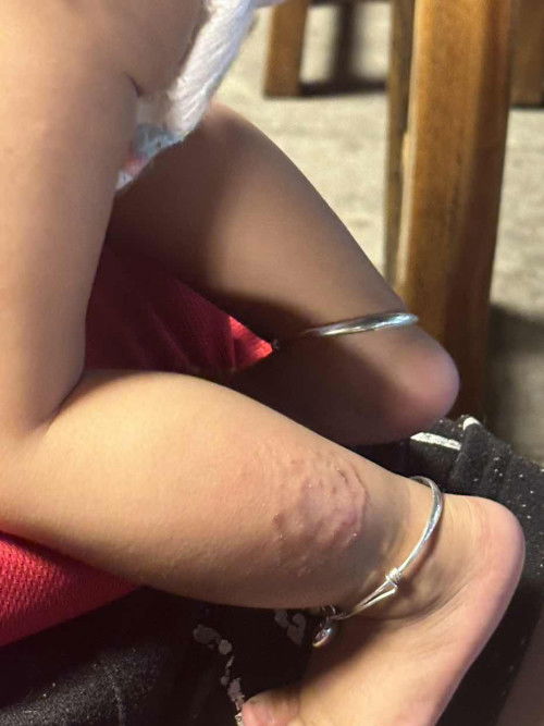 สอบถามแผลที่ขาน้องค่ะ